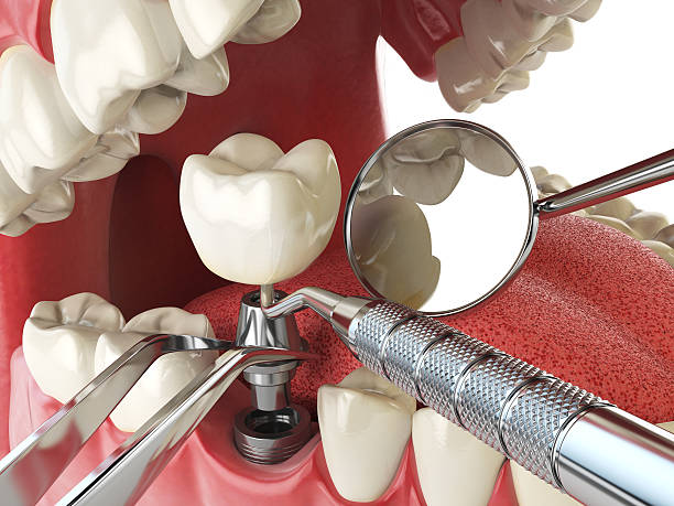 Best Emergency Treatment for Dental Infections or Abscesses in Penrose, CO